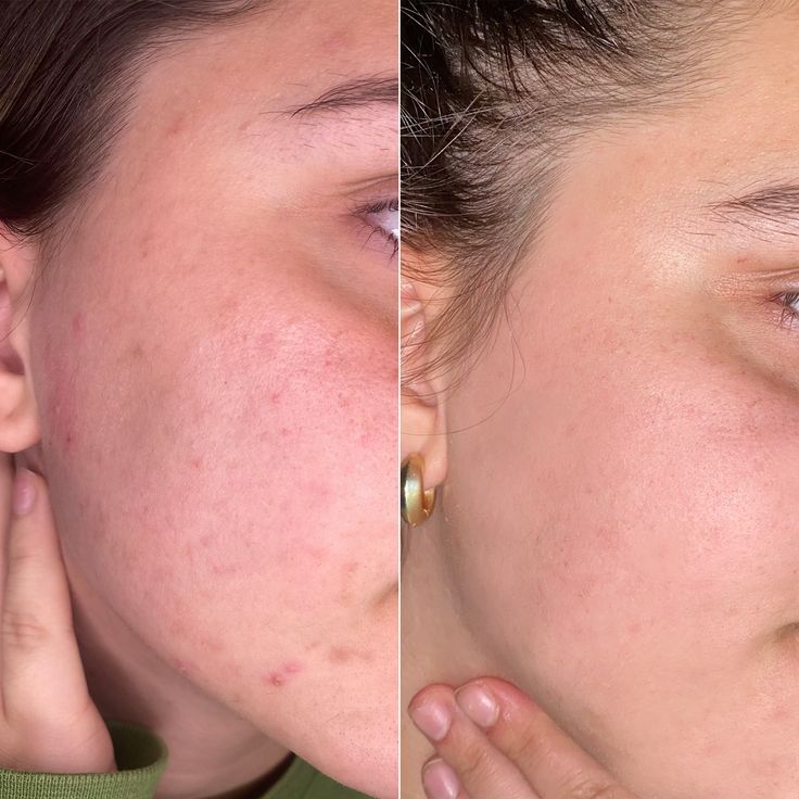 كريم الريتنول